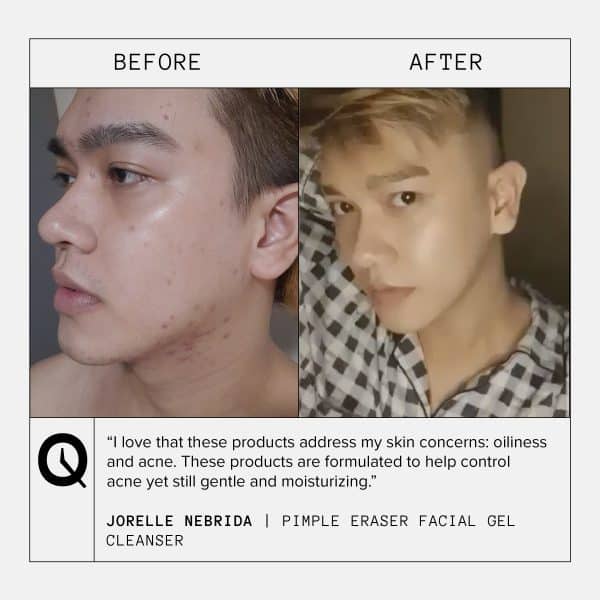QUICKFX - Pimple Eraser Facial Gel Cleanser